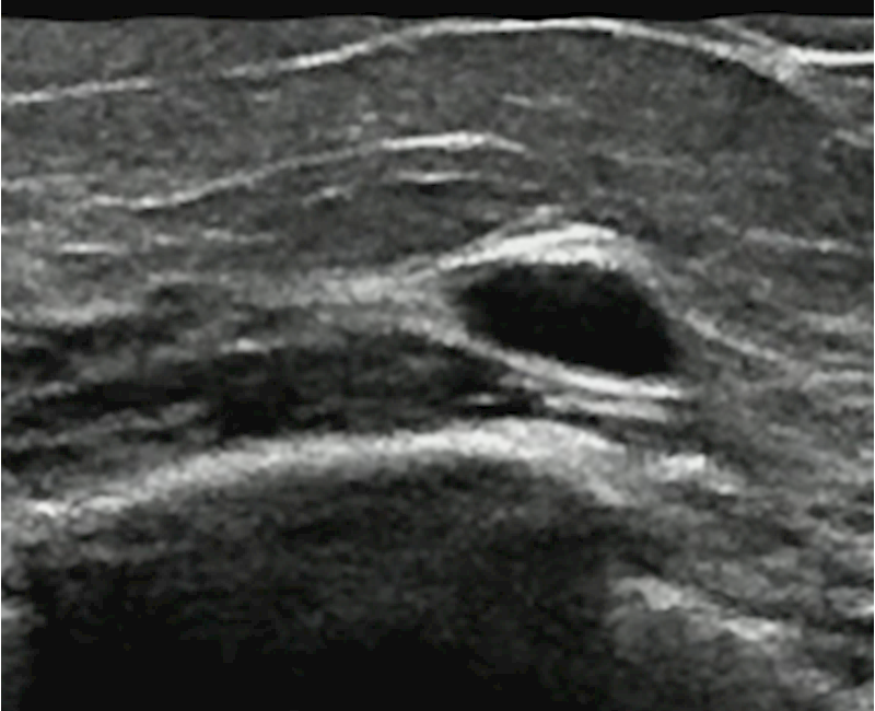 Chest wall ultrasound good alternative after mastectomy